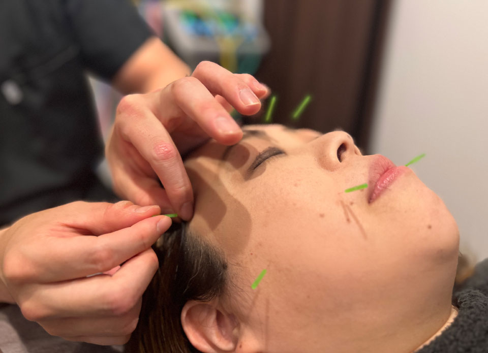 美容鍼
